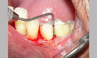 Dental jewellery treatment in Anand
                        